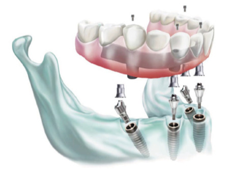 OKTAGON® Multi-Unit abutmenty Meisinger Implants